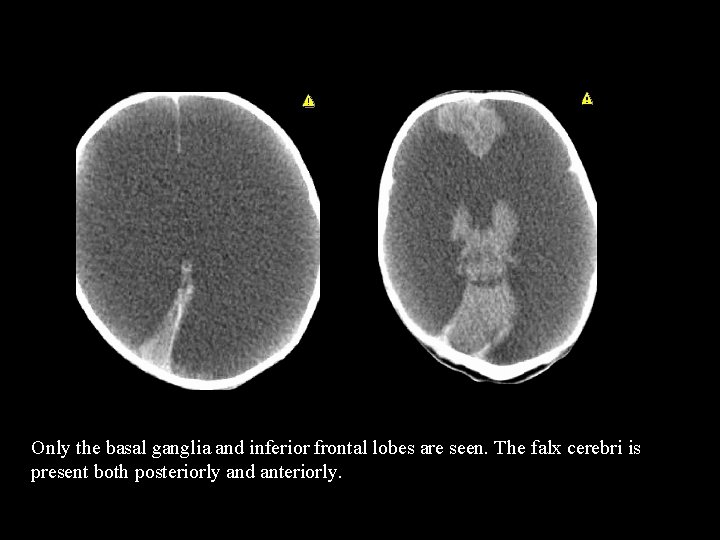 Only the basal ganglia and inferior frontal lobes are seen. The falx cerebri is