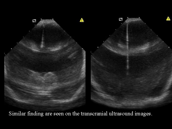 Similar finding are seen on the transcranial ultrasound images. 