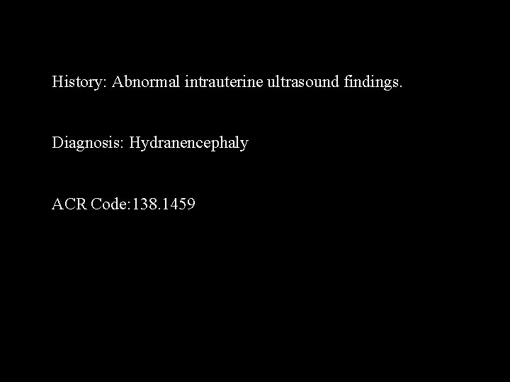 History: Abnormal intrauterine ultrasound findings. Diagnosis: Hydranencephaly ACR Code: 138. 1459 