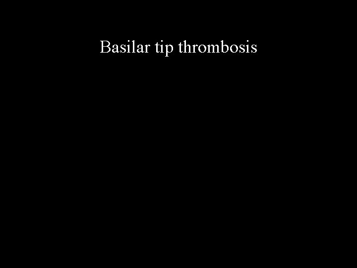 Basilar tip thrombosis 