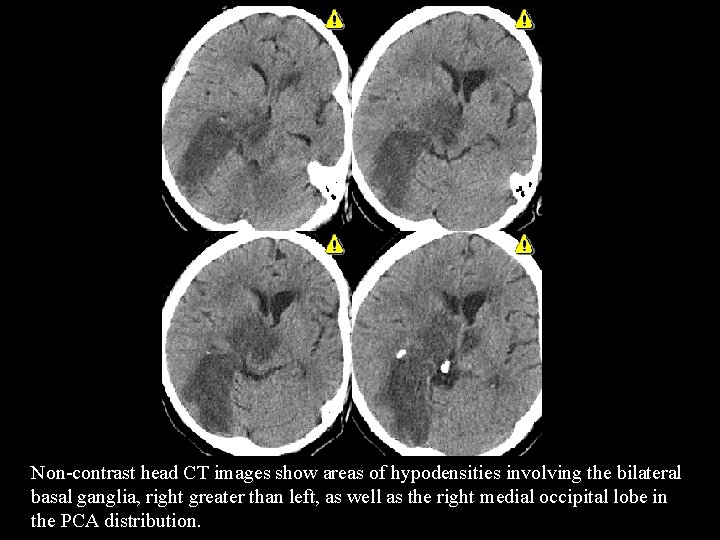 Non-contrast head CT images show areas of hypodensities involving the bilateral basal ganglia, right