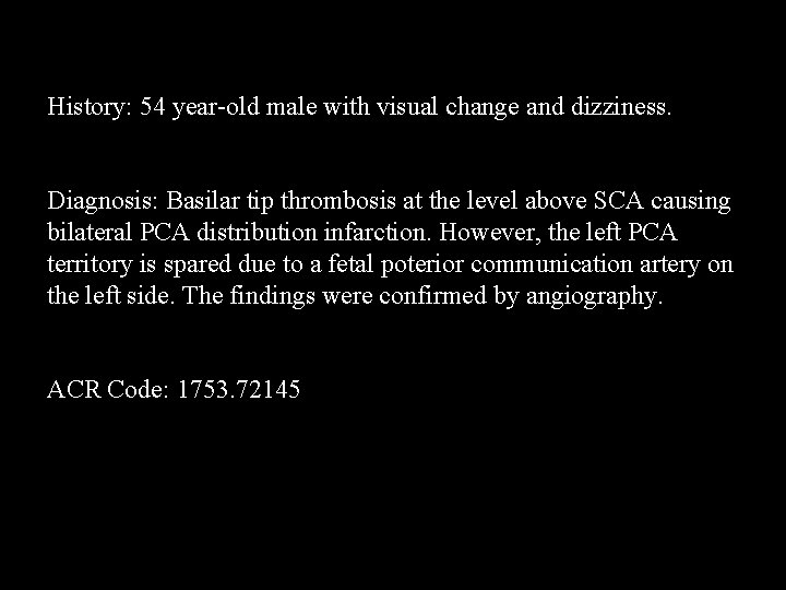 History: 54 year-old male with visual change and dizziness. Diagnosis: Basilar tip thrombosis at