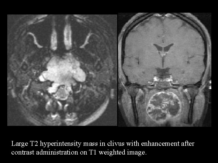 Large T 2 hyperintensity mass in clivus with enhancement after contrast administration on T