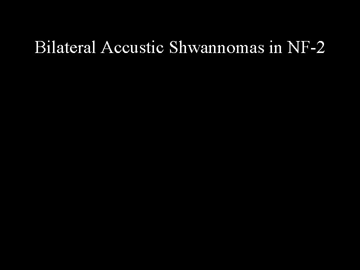 Bilateral Accustic Shwannomas in NF-2 