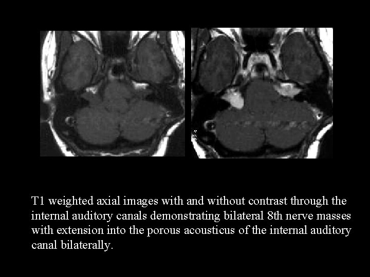 T 1 weighted axial images with and without contrast through the internal auditory canals