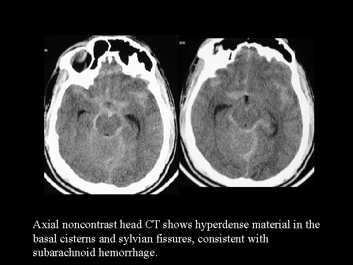 Axial noncontrast head CT shows hyperdense material in the basal cisterns and sylvian fissures,