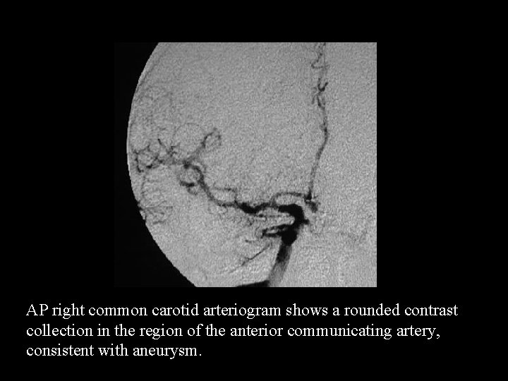 AP right common carotid arteriogram shows a rounded contrast collection in the region of