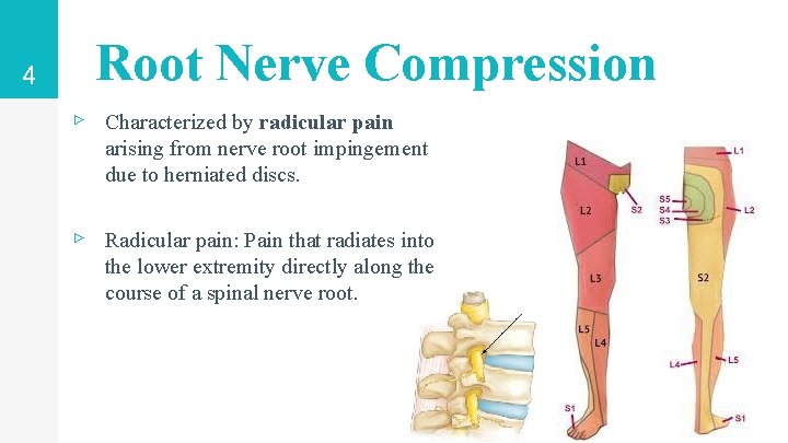 4 Root Nerve Compression ▹ Characterized by radicular pain arising from nerve root impingement 4 Root Nerve Compression ▹ Characterized by radicular pain arising from nerve root impingement