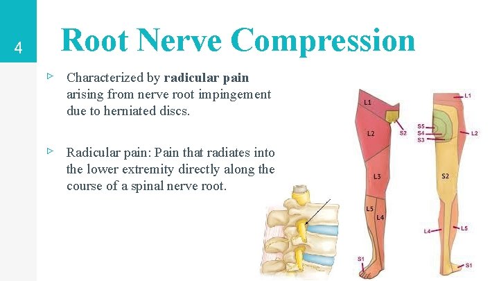 4 Root Nerve Compression ▹ Characterized by radicular pain arising from nerve root impingement