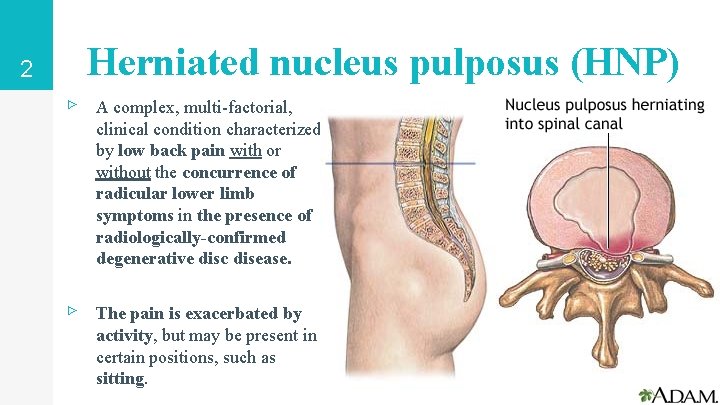 Herniated nucleus pulposus (HNP) 2 ▹ A complex, multi-factorial, clinical condition characterized by low Herniated nucleus pulposus (HNP) 2 ▹ A complex, multi-factorial, clinical condition characterized by low