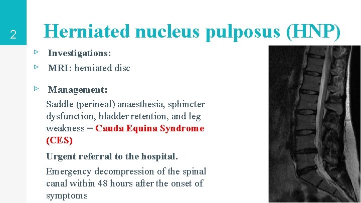 2 Herniated nucleus pulposus (HNP) ▹ Investigations: ▹ MRI: herniated disc ▹ Management: Saddle 2 Herniated nucleus pulposus (HNP) ▹ Investigations: ▹ MRI: herniated disc ▹ Management: Saddle