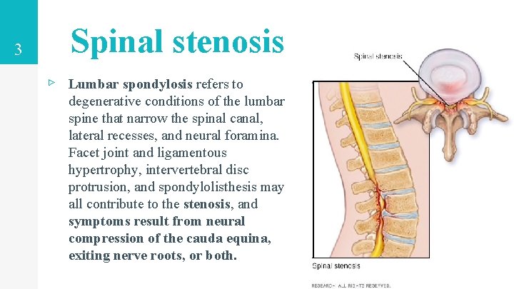 3 Spinal stenosis ▹ Lumbar spondylosis refers to degenerative conditions of the lumbar spine 3 Spinal stenosis ▹ Lumbar spondylosis refers to degenerative conditions of the lumbar spine