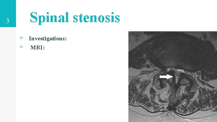 3 Spinal stenosis ▹ Investigations: ▹ MRI: 