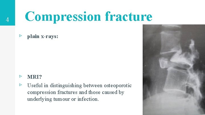 4 Compression fracture ▹ plain x-rays: ▹ MRI? ▹ Useful in distinguishing between osteoporotic 4 Compression fracture ▹ plain x-rays: ▹ MRI? ▹ Useful in distinguishing between osteoporotic