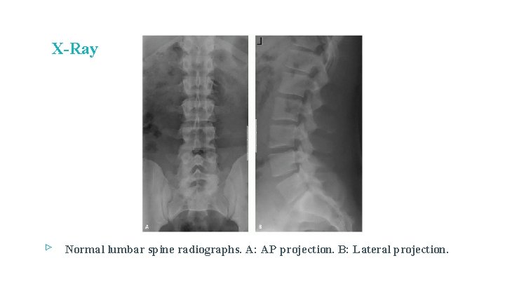 X-Ray ▹ Normal lumbar spine radiographs. A: AP projection. B: Lateral projection. 