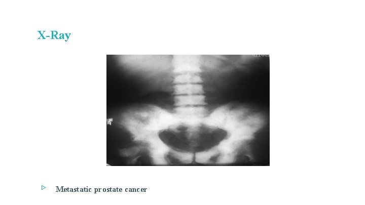 X-Ray ▹ Metastatic prostate cancer 