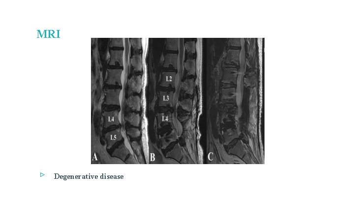 MRI ▹ Degenerative disease 