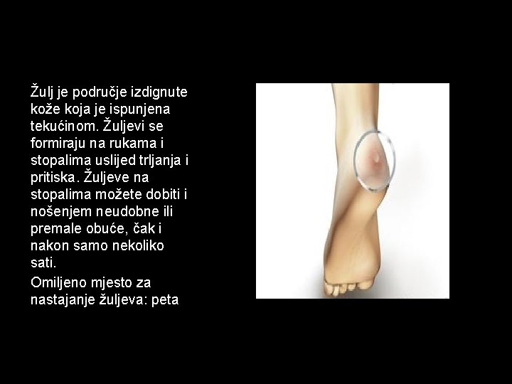 Žulj je područje izdignute kože koja je ispunjena tekućinom. Žuljevi se formiraju na rukama