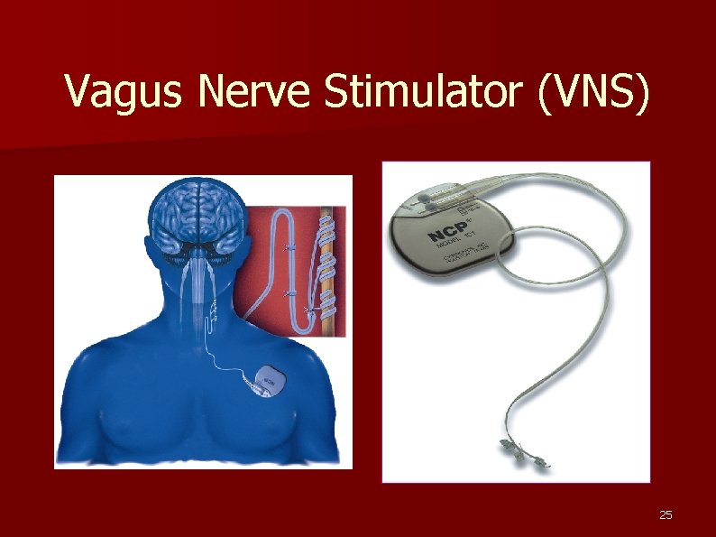 Vagus Nerve Stimulator (VNS) 25 