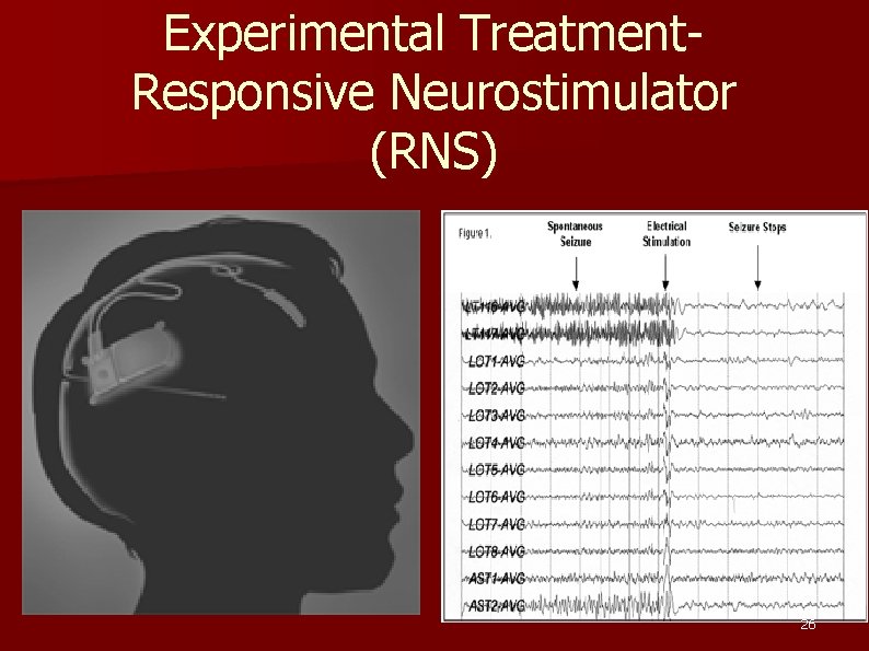 Experimental Treatment. Responsive Neurostimulator (RNS) 26 