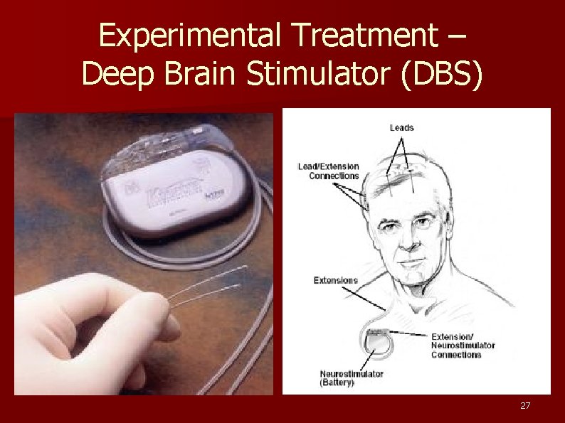 Experimental Treatment – Deep Brain Stimulator (DBS) 27 