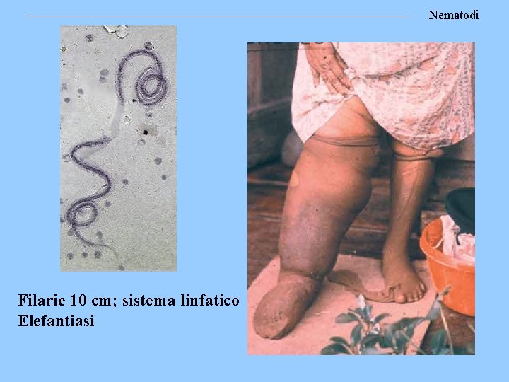Nematodi Filarie 10 cm; sistema linfatico Elefantiasi 