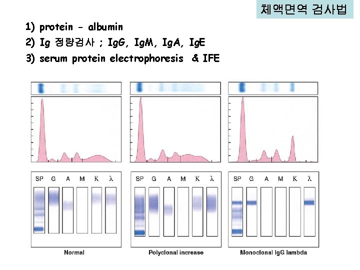 체액면역 검사법 1) protein - albumin 2) Ig 정량검사 ; Ig. G, Ig. M,