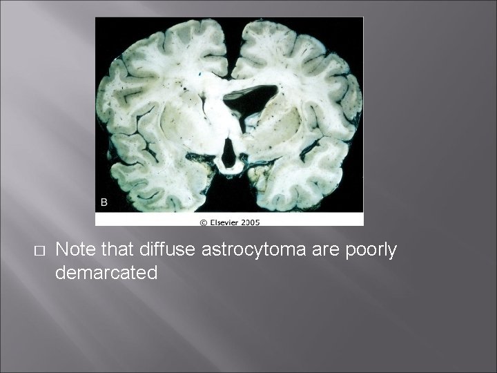 � Note that diffuse astrocytoma are poorly demarcated 