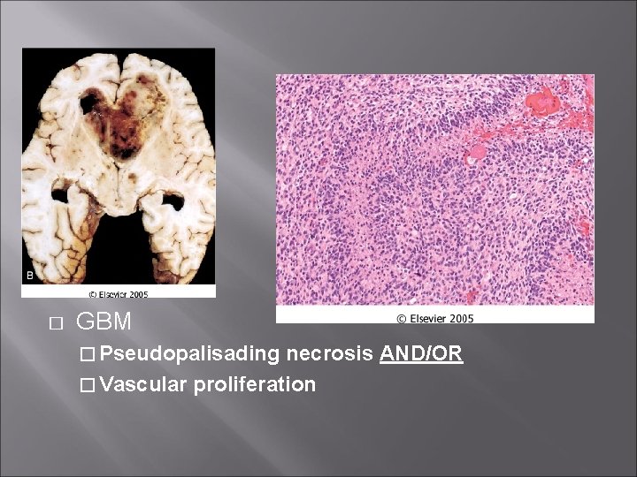 � GBM � Pseudopalisading necrosis AND/OR � Vascular proliferation 