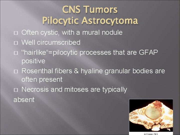 CNS Tumors Pilocytic Astrocytoma Often cystic, with a mural nodule � Well circumscribed �
