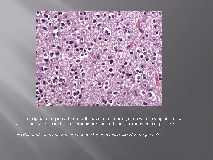  • • In oligodendroglioma tumor cells have round nuclei, often with a cytoplasmic