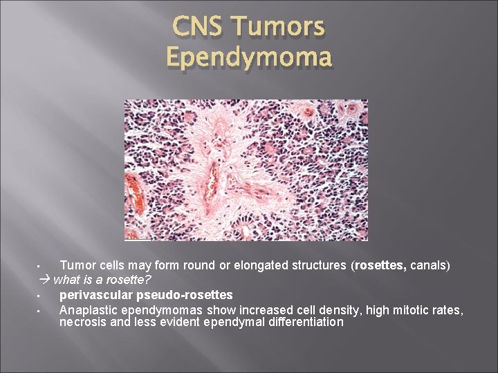 CNS Tumors Ependymoma Tumor cells may form round or elongated structures (rosettes, canals) what