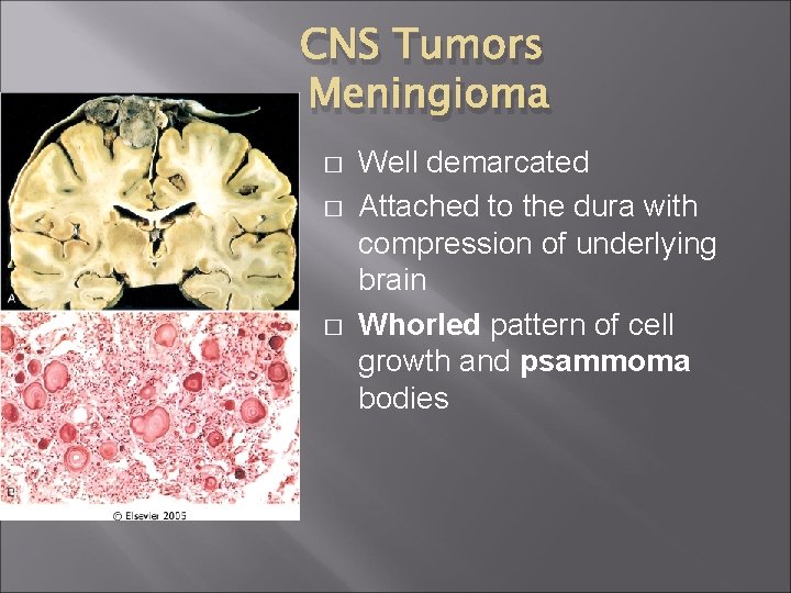 CNS Tumors Meningioma � � � Well demarcated Attached to the dura with compression