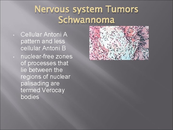 Nervous system Tumors Schwannoma • • Cellular Antoni A pattern and less cellular Antoni