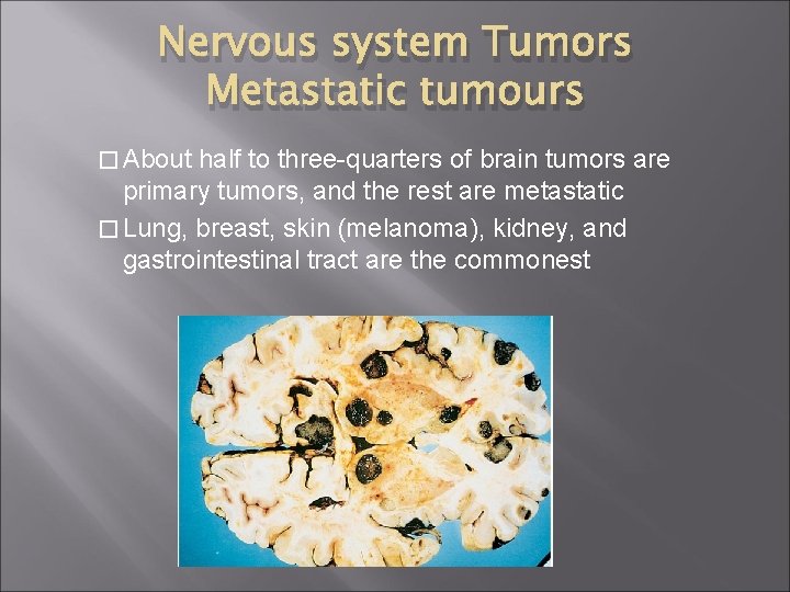 Nervous system Tumors Metastatic tumours � About half to three-quarters of brain tumors are