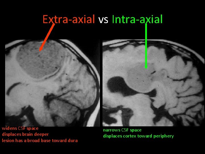 Extra-axial vs Intra-axial widens CSF space displaces brain deeper lesion has a broad base