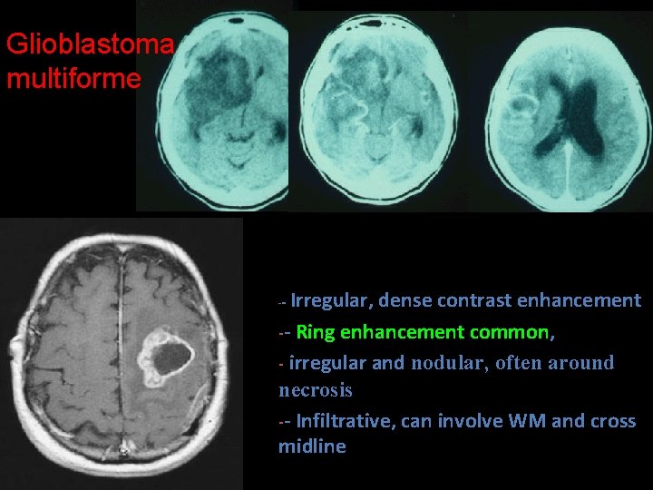 Glioblastoma multiforme Irregular, dense contrast enhancement -- Ring enhancement common, - irregular and nodular,