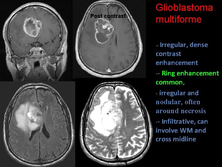Post contrast Glioblastoma multiforme Irregular, dense contrast enhancement -- Ring enhancement common, - irregular