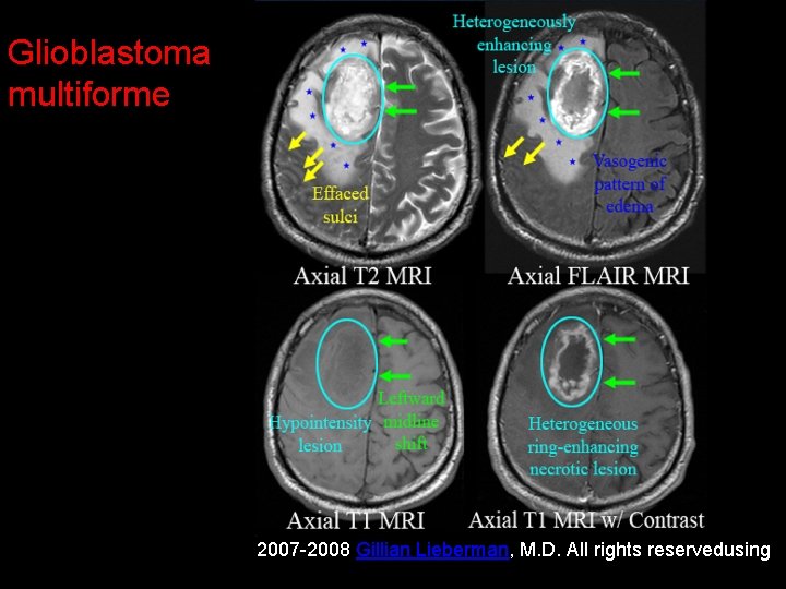 Glioblastoma multiforme 2007 -2008 Gillian Lieberman, M. D. All rights reservedusing 