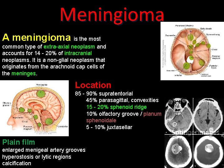 Meningioma A meningioma is the most common type of extra-axial neoplasm and accounts for