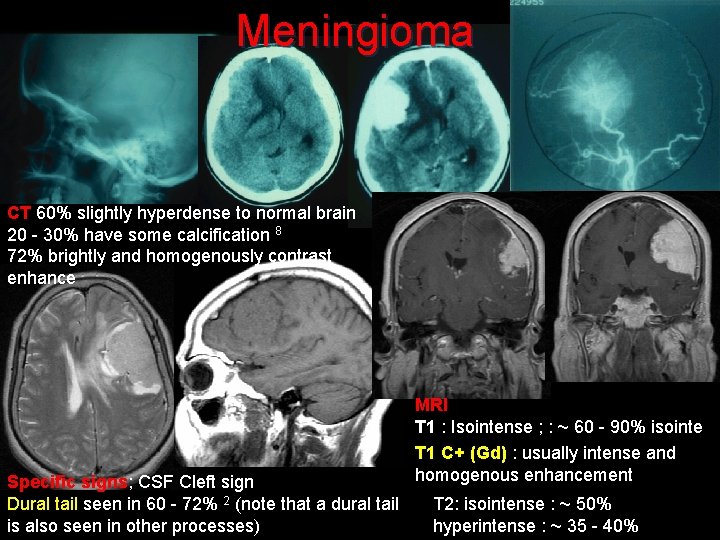 Meningioma CT 60% slightly hyperdense to normal brain 20 - 30% have some calcification