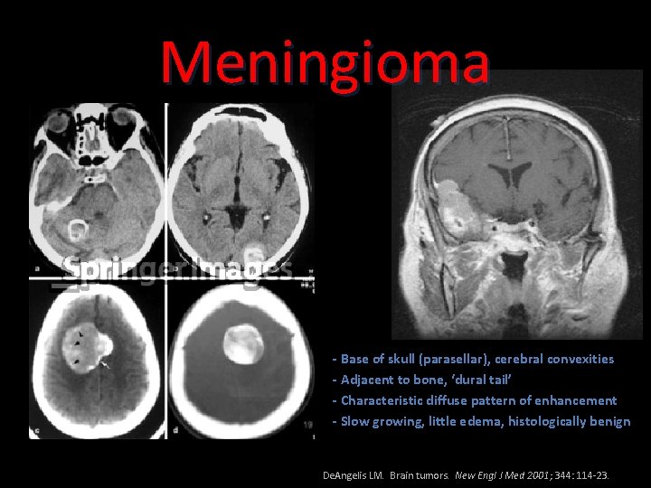 Meningioma - Base of skull (parasellar), cerebral convexities - Adjacent to bone, ‘dural tail’