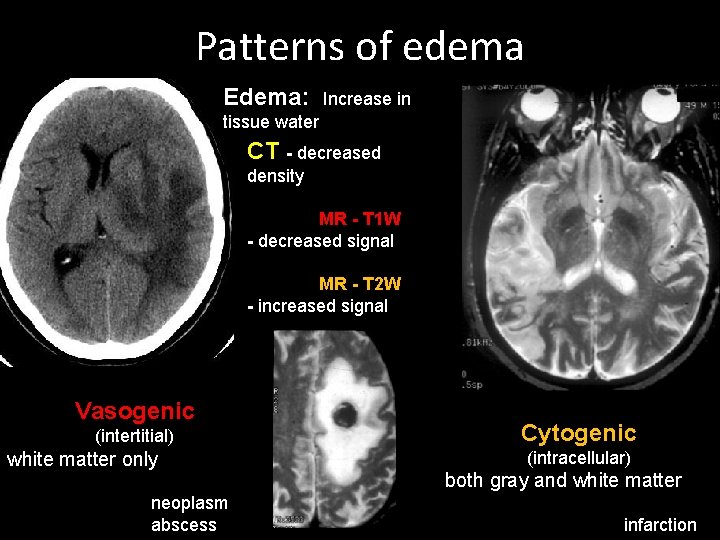 Patterns of edema Edema: Increase in tissue water CT - decreased density MR -