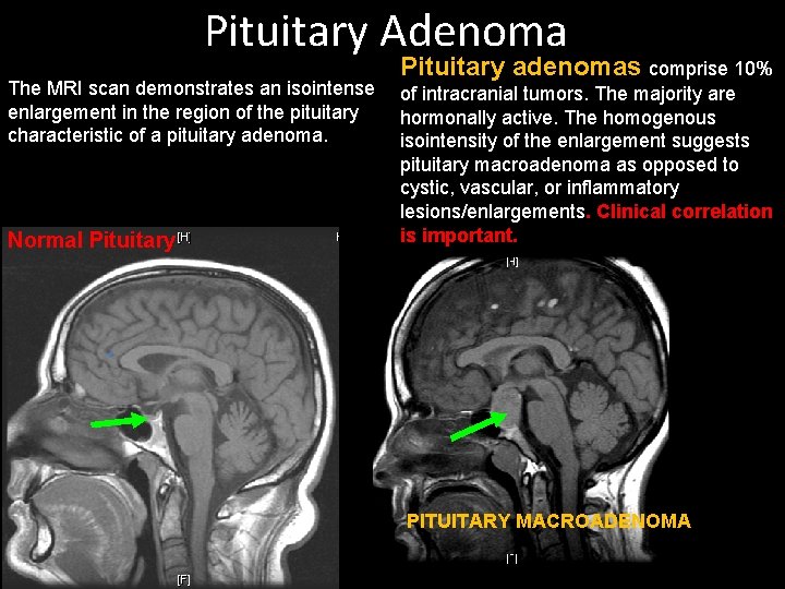Pituitary Adenoma The MRI scan demonstrates an isointense enlargement in the region of the