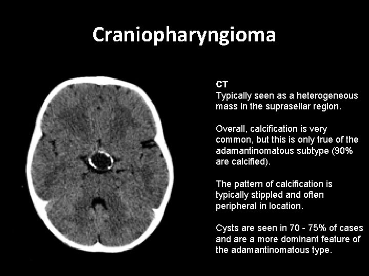 Craniopharyngioma CT Typically seen as a heterogeneous mass in the suprasellar region. Overall, calcification