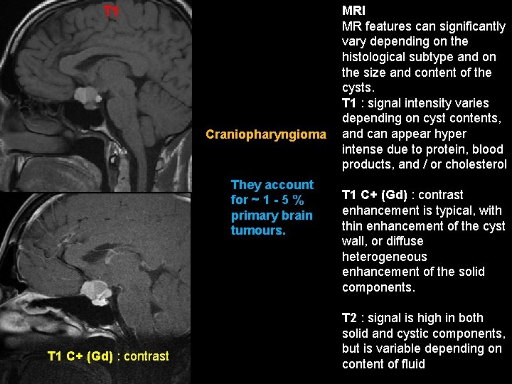 T 1 Craniopharyngioma They account for ~ 1 - 5 % primary brain tumours.