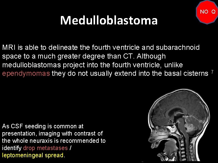 Medulloblastoma NO Q MRI is able to delineate the fourth ventricle and subarachnoid space