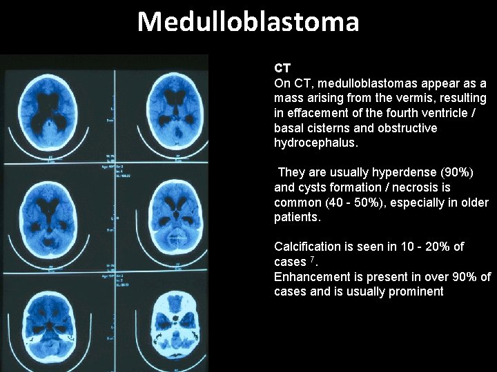 Medulloblastoma CT On CT, medulloblastomas appear as a mass arising from the vermis, resulting