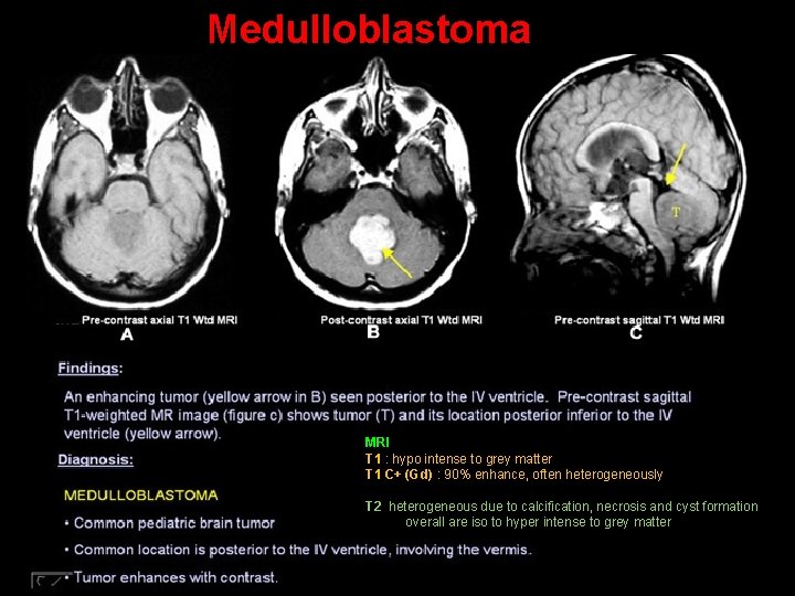 Medulloblastoma MRI T 1 : hypo intense to grey matter T 1 C+ (Gd)