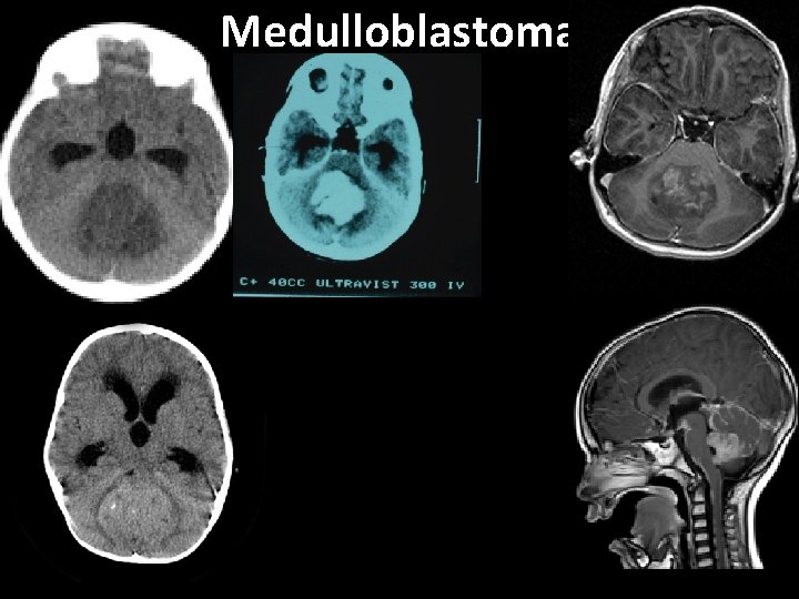 Medulloblastoma 